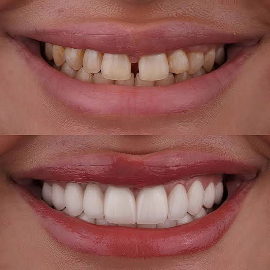 Gülüş tasarımı öncesi ve sonrası diş görünümü – temsili görsel