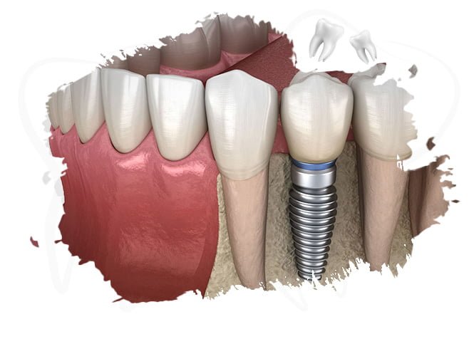 Çene kemiğine yerleştirilen diş implantı – üç boyutlu anlatım görseli